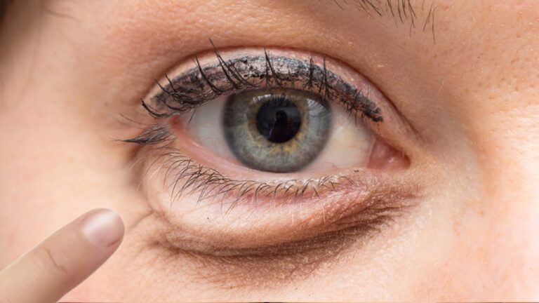 15 Proven Tips to Eliminate Under Eye Bags for a Bright, Youthful Look!