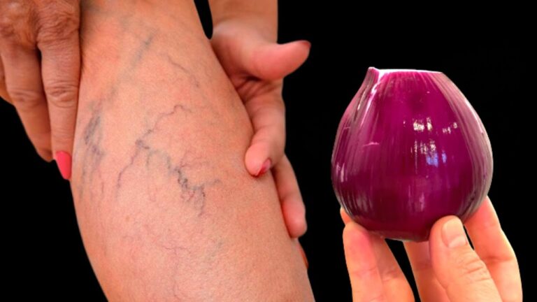 10 Remedies to Relieve Joint Pain and Varicose Veins Naturally