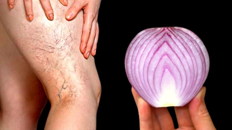7 Surprising Remedies to Erase Varicose Veins for Good! Discover the Secrets!