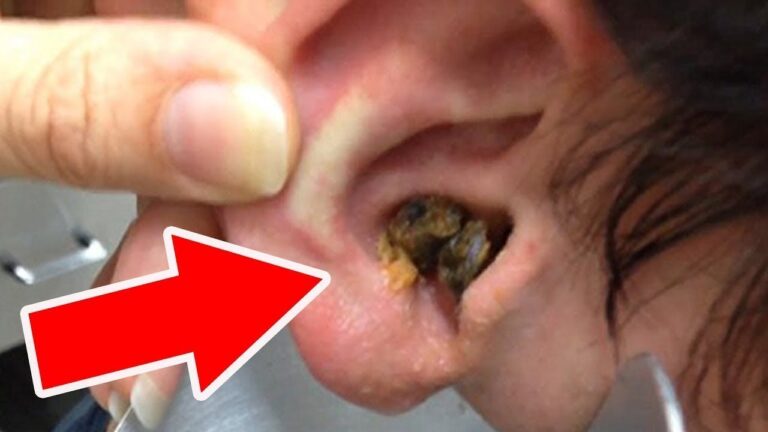 Say Goodbye to Excess Earwax in Just 10 Minutes with This Simple Home Trick!