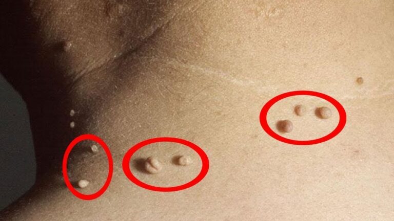 10 Fast and Easy Home Remedies to Get Rid of Skin Tags Today!