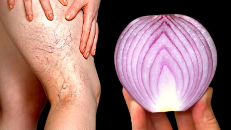 Say Goodbye to Varicose Veins: 5 Easy Tips for Instant Relief!