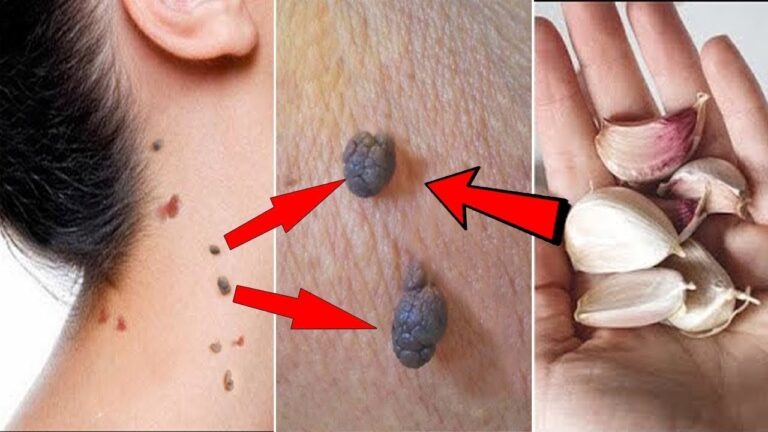 8 Simple Steps to Effectively Remove Skin Tags at Home