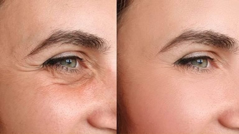 This Natural Cream Banishes Crow’s Feet in Just One Week