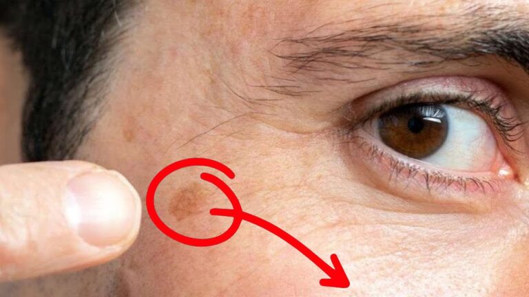 5 Signs You’re Lacking This Mineral and How to Fix Age Spots Naturally!