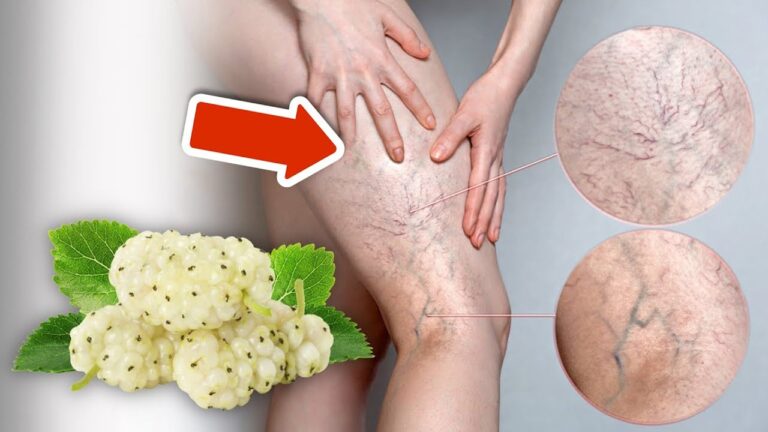 10 Secret Remedies to Banish Varicose Veins Forever!