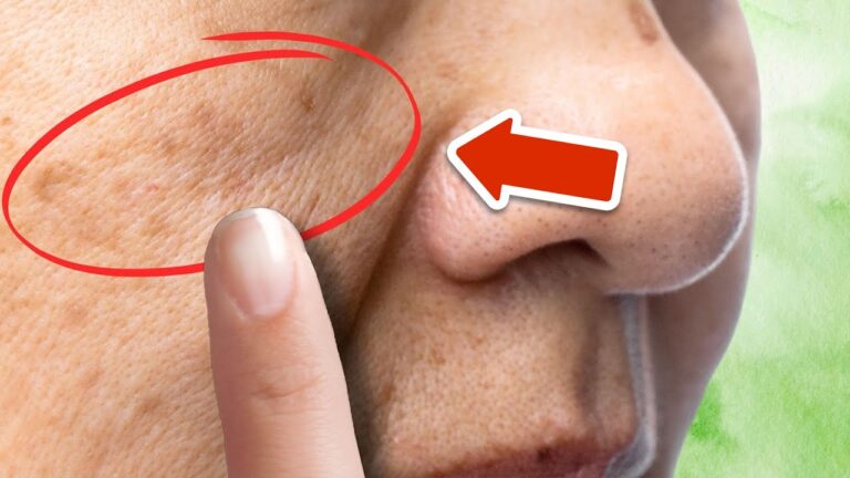 Eliminate 7 Types of Age Spots Forever with This Simple Plant Solution!
