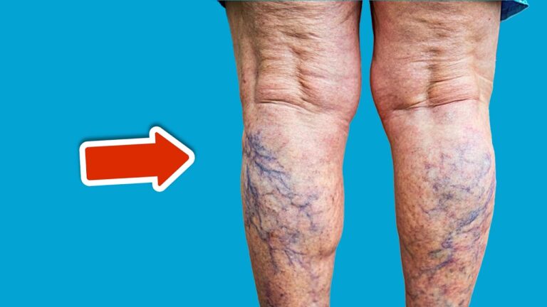 Discover the 1 Vitamin Everyone Needs for Varicose Veins That You Probably Don’t Know!