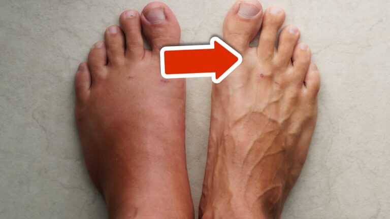 Discover 5 Secrets to Ditch Swelling in Your Legs, Ankles, and Feet!