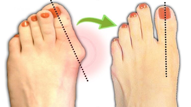 7 Effective Exercises to Alleviate Pain from Overgrowths on Your Feet
