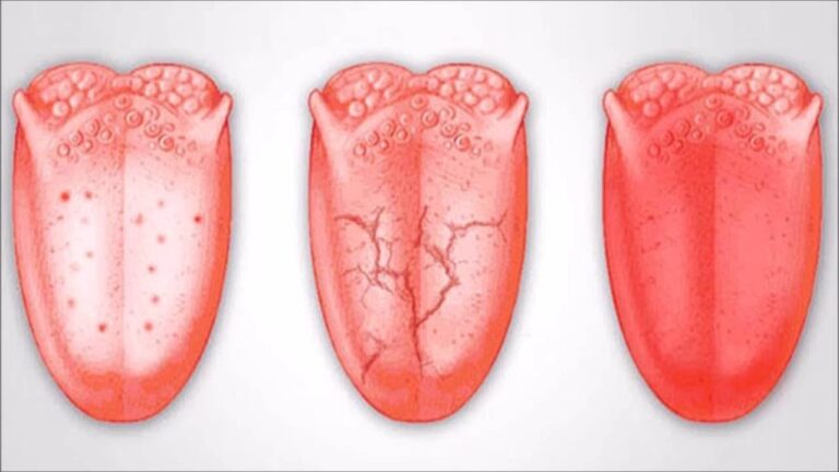 7 Surprising Health Signs Your Tongue Can Reveal About You